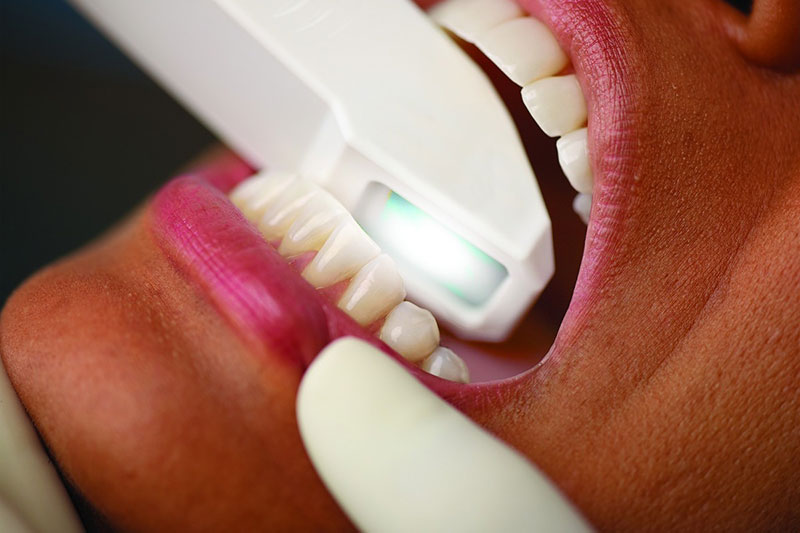 Aligner-Schienen Impression