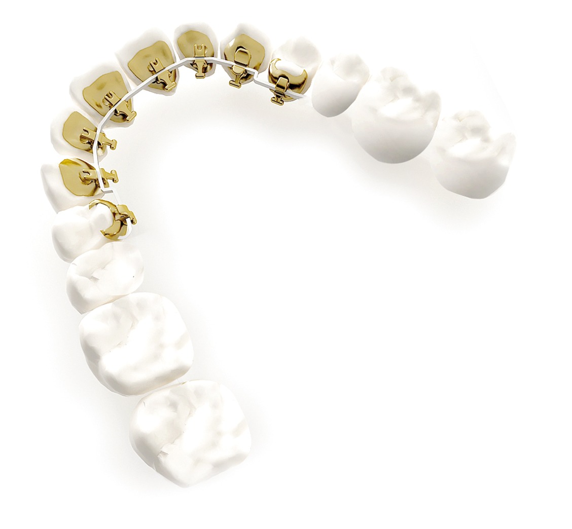 Kieferorthopädie für Erwachsene