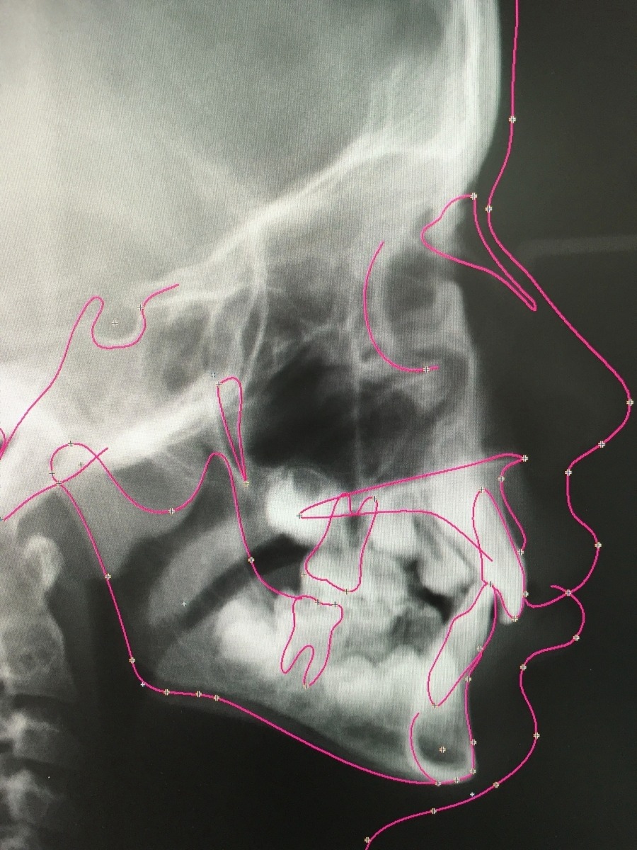 Digitale Kieferorthopädie – Ergebnis