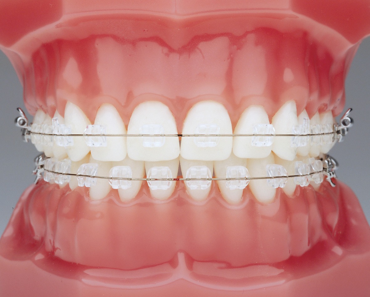 Keramikbrackets – Ergebnis