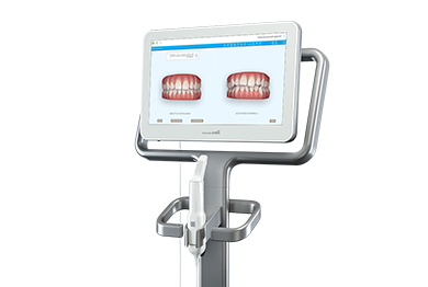 Intraoralscanner – Scan statt Abdruck