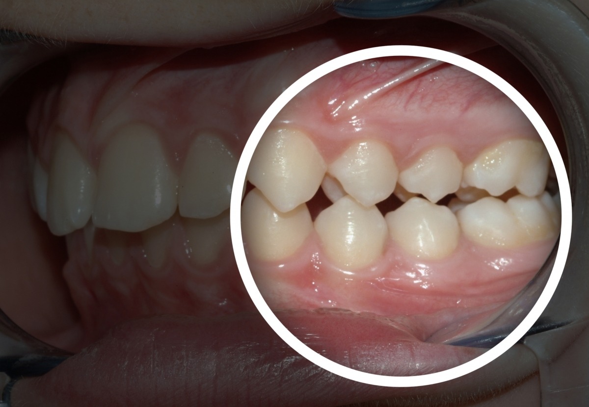 Herausnehmbare Zahnspangen – Detail